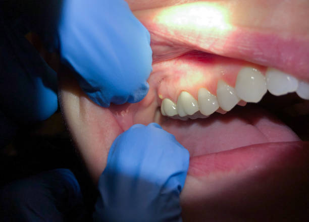 Best Emergency Dentist for Lost Fillings or Crowns in Grand Prairie, TX